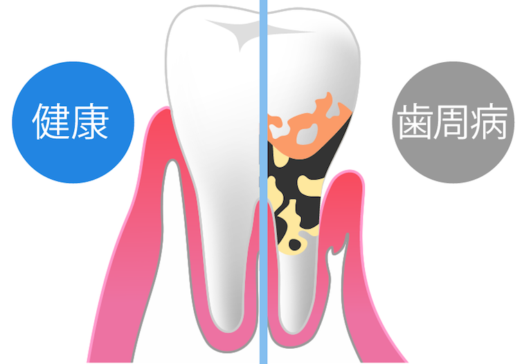 歯周病の例
