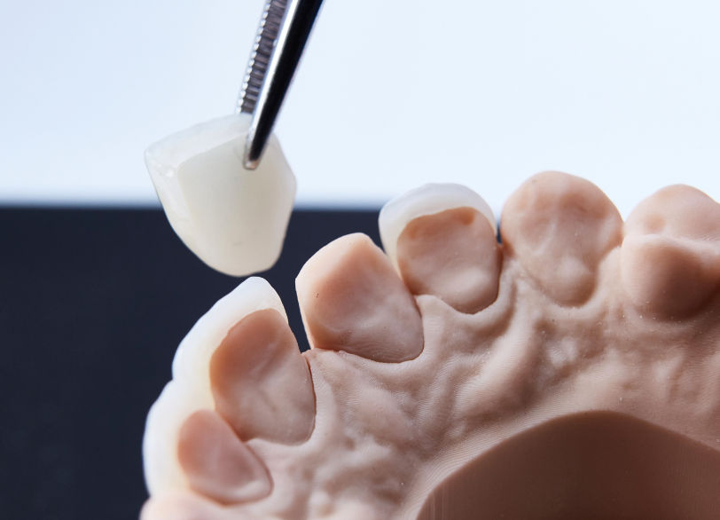 ラミネートベニア|クリア総合歯科