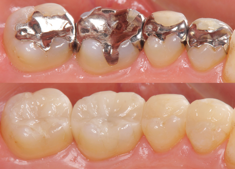 奥歯の銀歯を白くしたい|クリア総合歯科