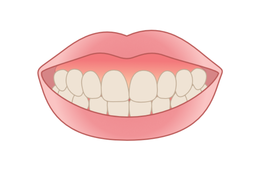 ガミースマイルの改善｜クリア総合歯科