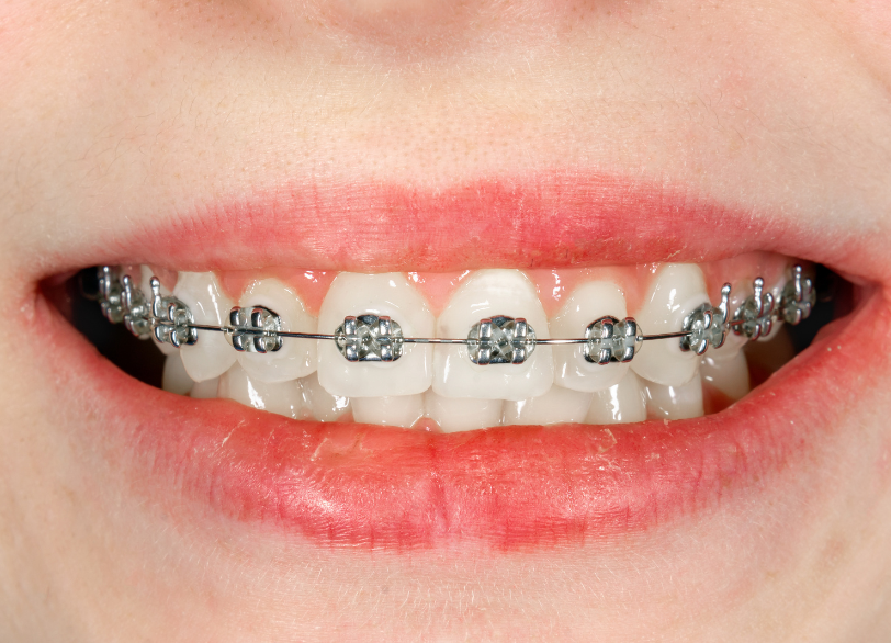 ワイヤー矯正｜クリア総合歯科