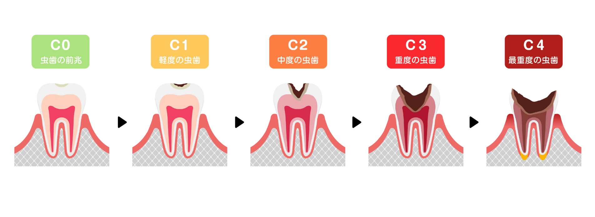 虫歯の進行｜クリア総合歯科