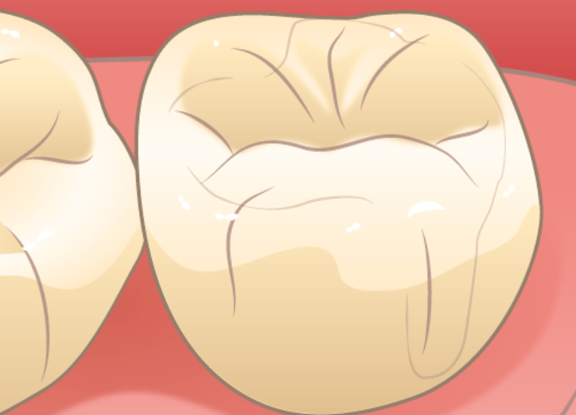 詰め物・被せ物の精密な適合｜クリア総合歯科