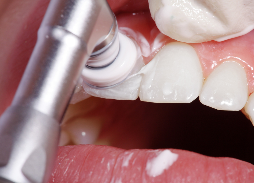 PMTC｜クリア総合歯科