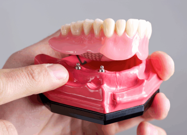インプラントオーバーデンチャー｜クリア総合歯科