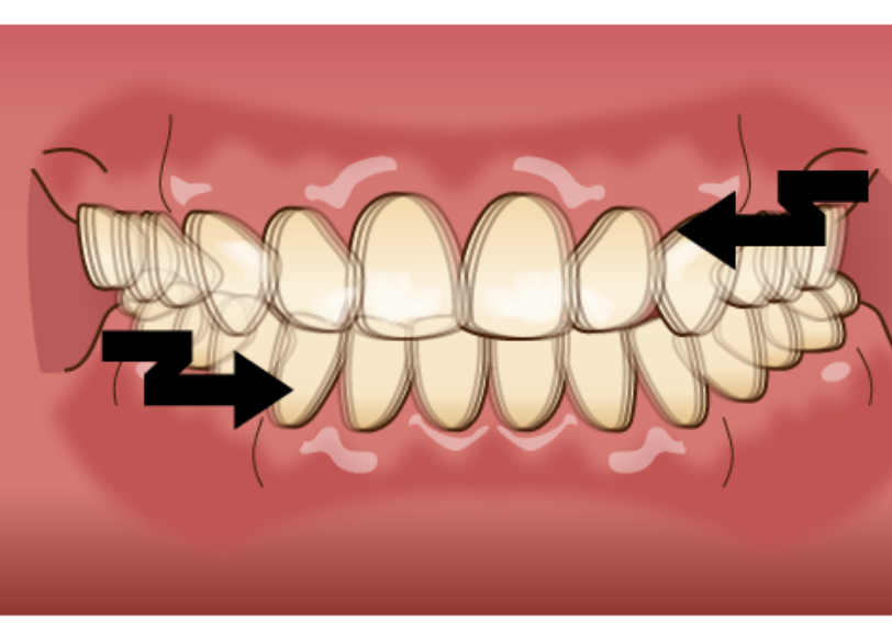 歯ぎしり｜クリア総合歯科