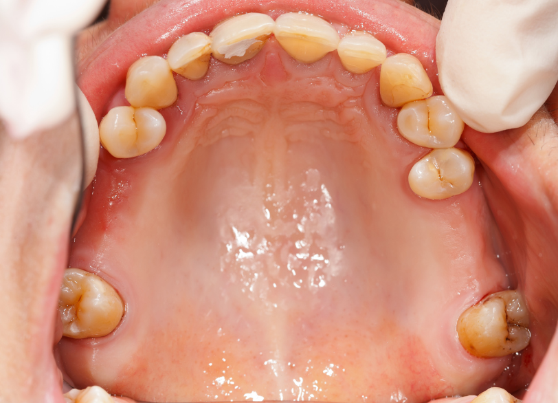 歯の喪失の放置｜クリア総合歯科