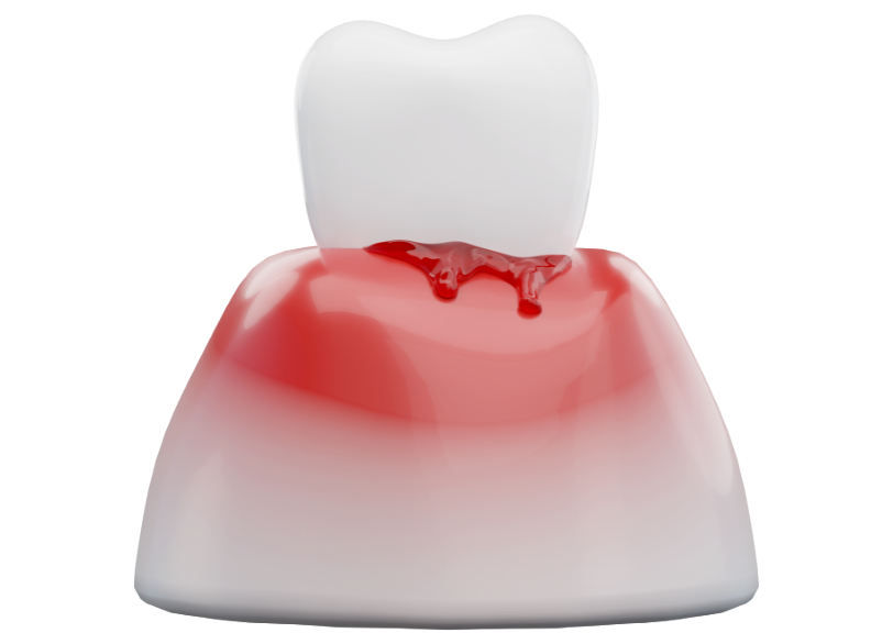 歯周病｜クリア総合歯科