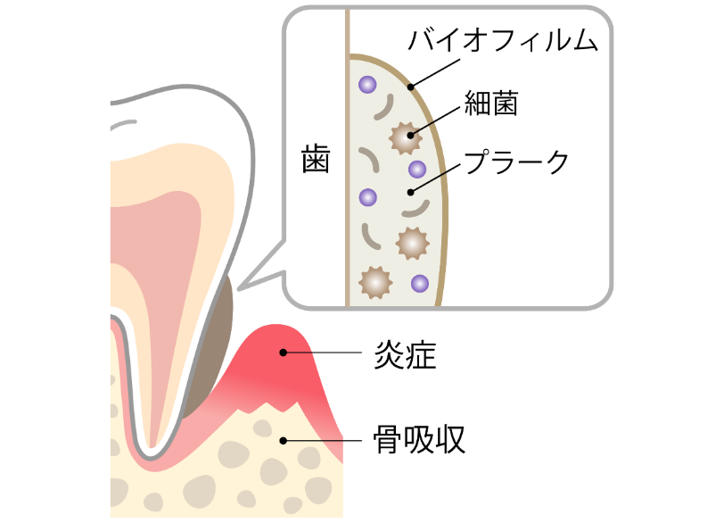 歯周病とは｜クリア総合歯科