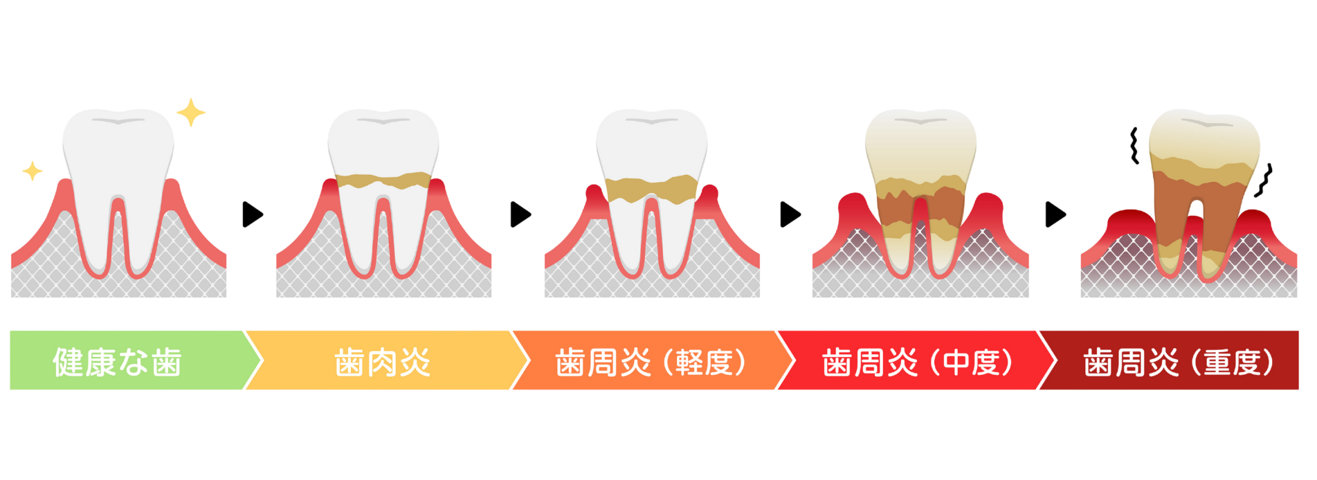歯周病の進行｜クリア総合歯科