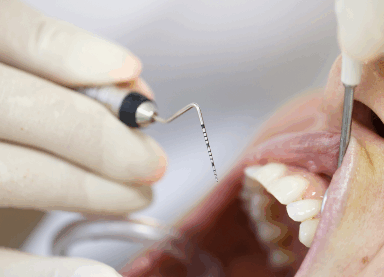 歯周ポケット検査｜クリア総合歯科