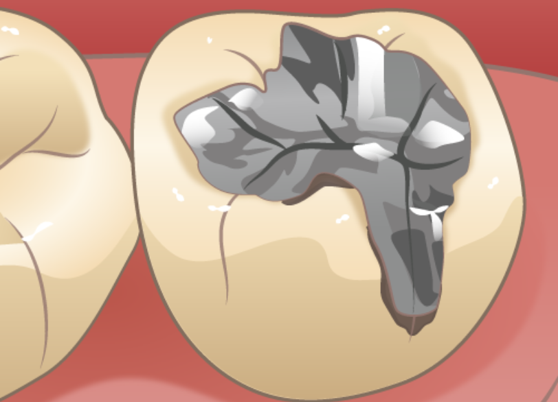 二次う蝕｜クリア総合歯科