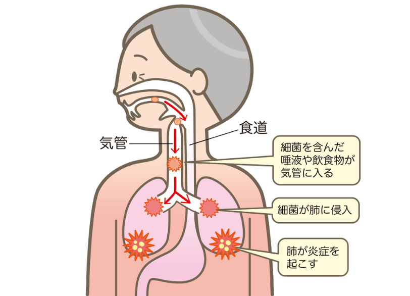 誤嚥性肺炎｜クリア総合歯科
