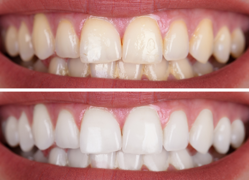 デュアルホワイトニング｜クリア総合歯科