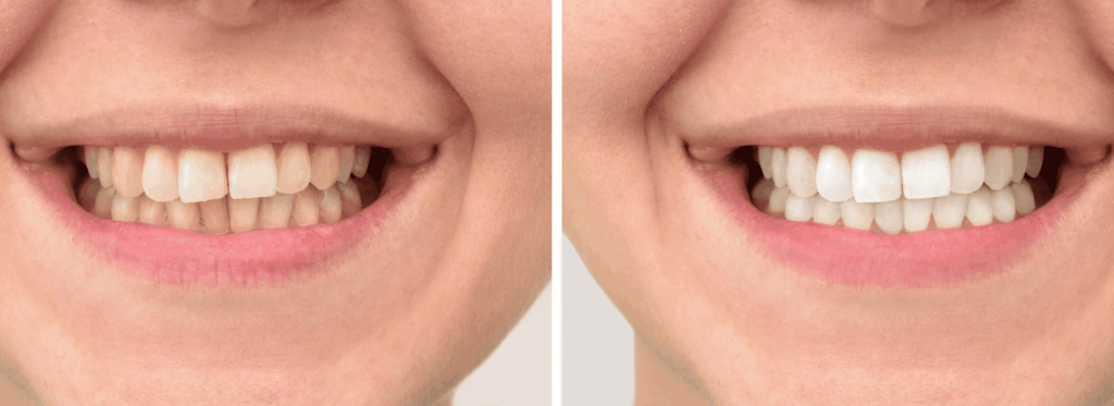 白さを長持ちさせるために｜クリア総合歯科