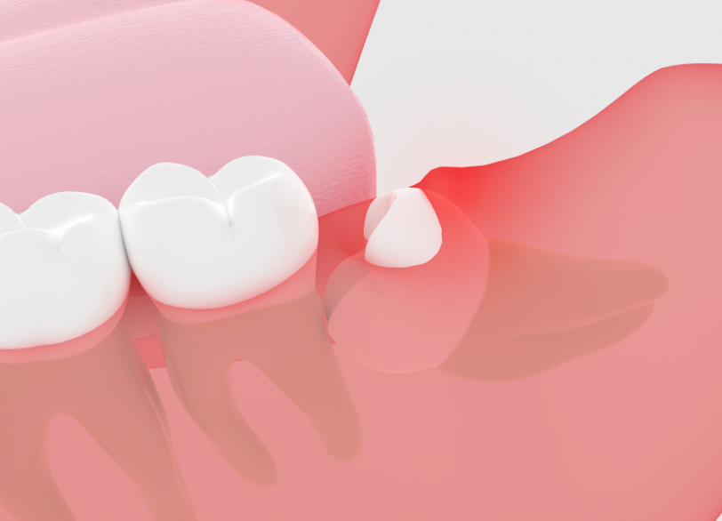 智歯周囲炎｜クリア総合歯科