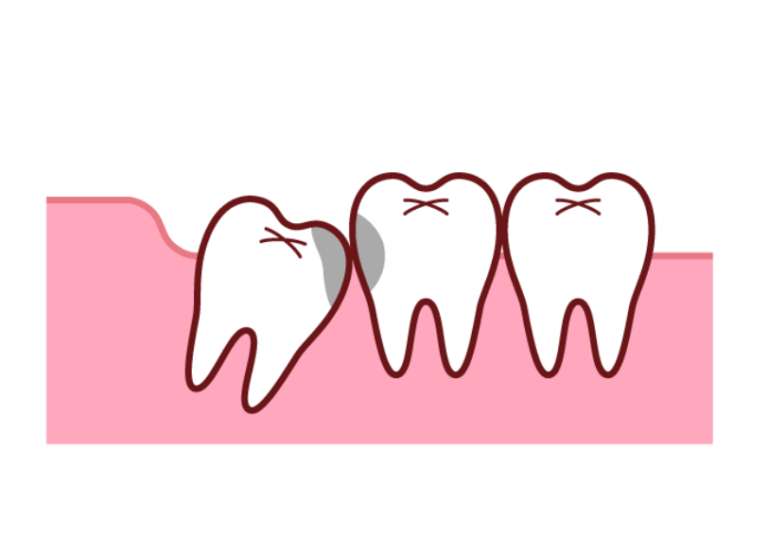 手前の大切な歯がむし歯になる｜クリア総合歯科