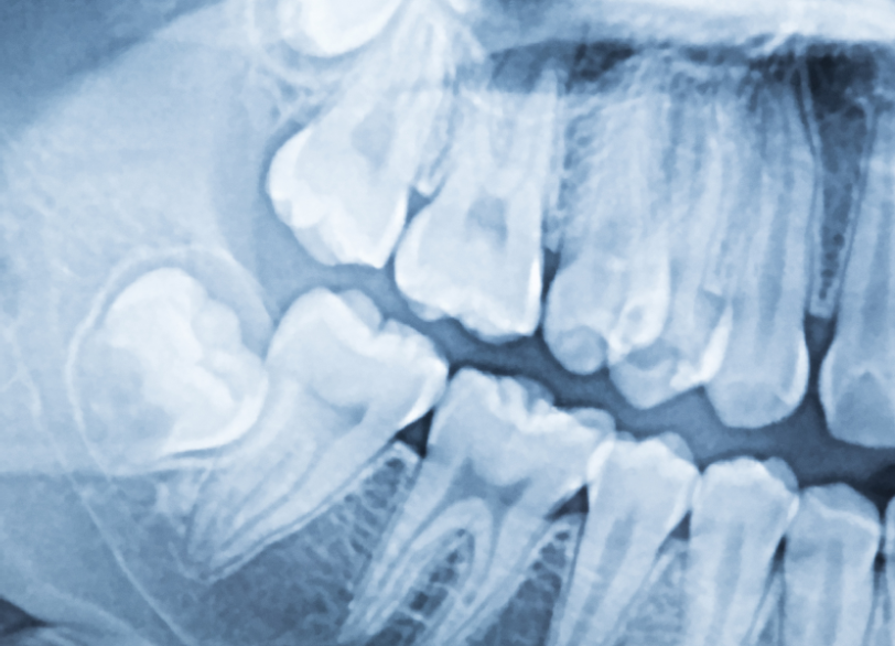 嚢胞（のうほう）の発生
｜クリア総合歯科