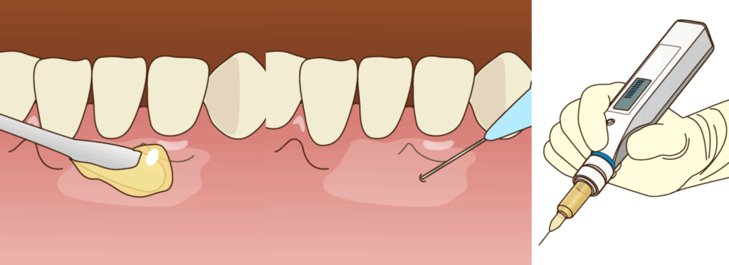 丁寧な麻酔で処置中の痛みをなくします｜クリア総合歯科