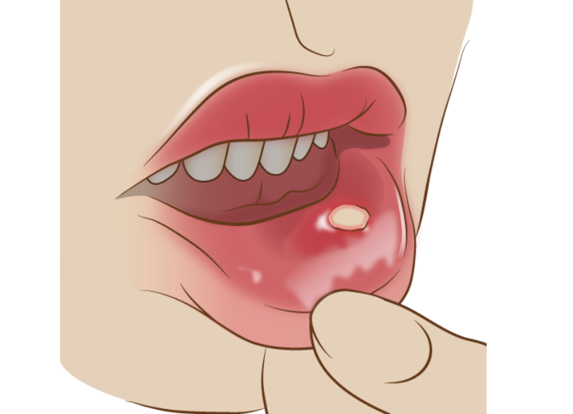 口腔粘膜疾患｜クリア総合歯科