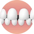 空隙歯列(くうげきしれつ)｜不正歯列