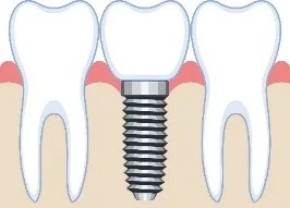 インプラントのイメージ