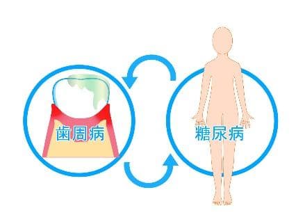 歯周病が糖尿病を悪化させるイメージ