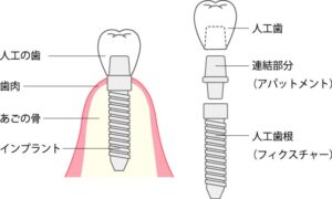 インプラント治療