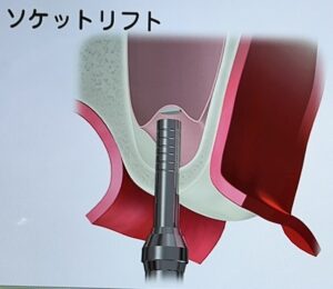 ソケットリフト