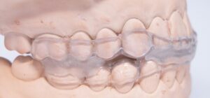 マウスピースによる治療のイメージ