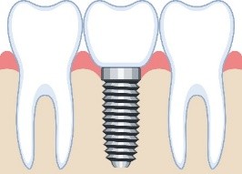 インプラントのイメージ