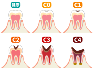 虫歯のメカニズム